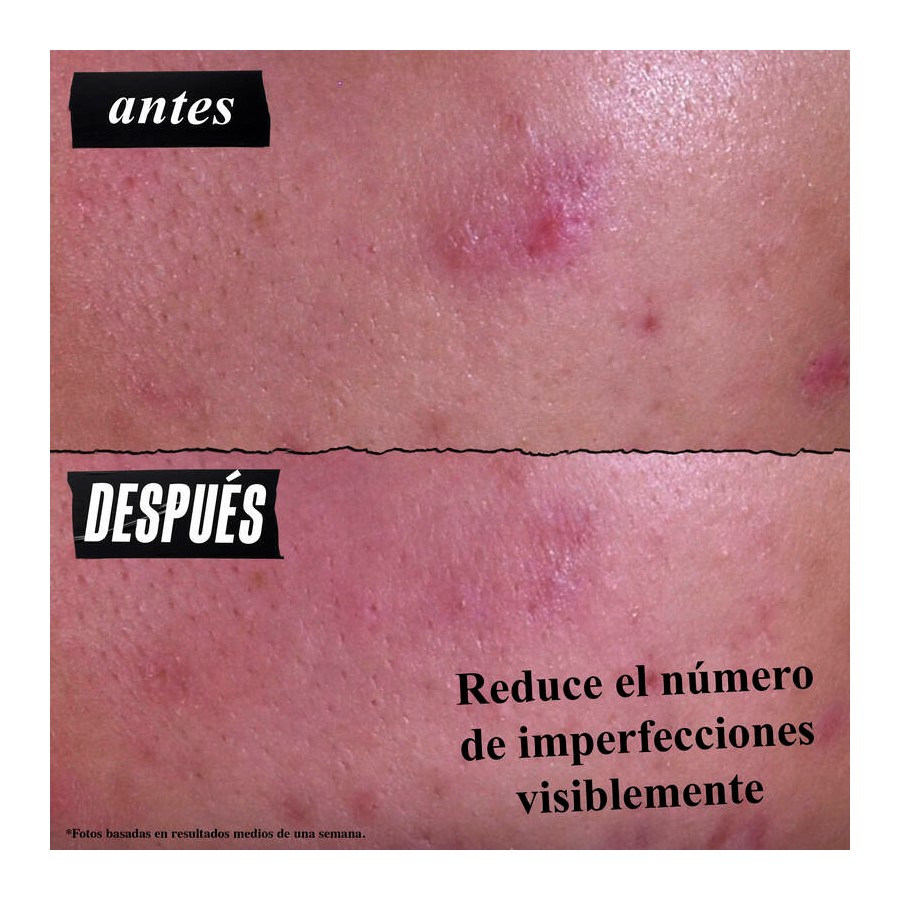 gently-effective-blemish-targeting-akne-reinigungsbehandlung