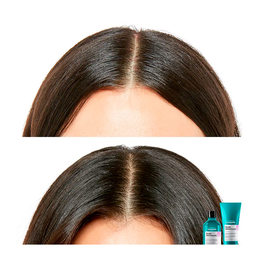 scalp-advanced-champu-anti-malestar
